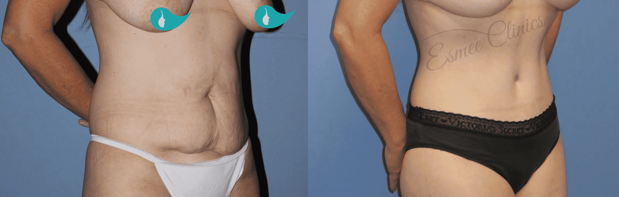 Before and After img